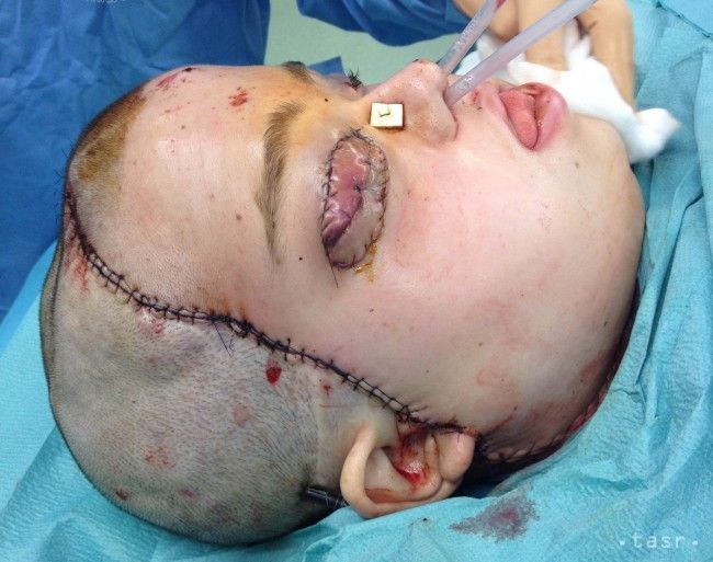 V Poľsku realizovali druhú transplantáciu tváre