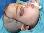 V Poľsku realizovali druhú transplantáciu tváre