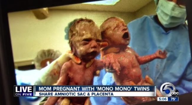 Video: Dvojičky sa narodili držiac sa za ruky