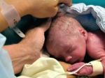 Prvé dieťa narodené z transplantovanej maternice je zdravé
