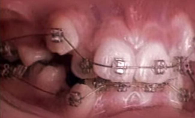 Video: Čo dokáže zubný strojček za 18 mesiacov