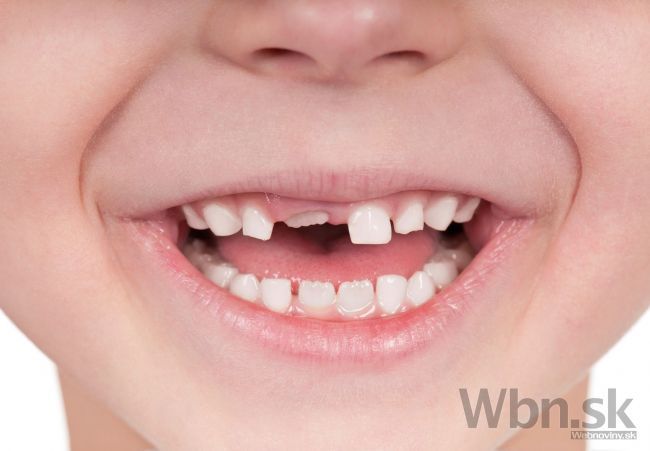 Zubný kaz si neliečia miliardy ľudí, vedci bijú na poplach
