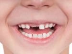 Zubný kaz si neliečia miliardy ľudí, vedci bijú na poplach