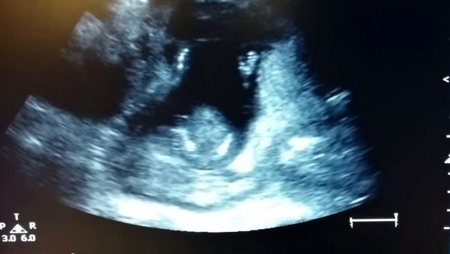 Video: Na ultrazvuku uvideli niečo krásne