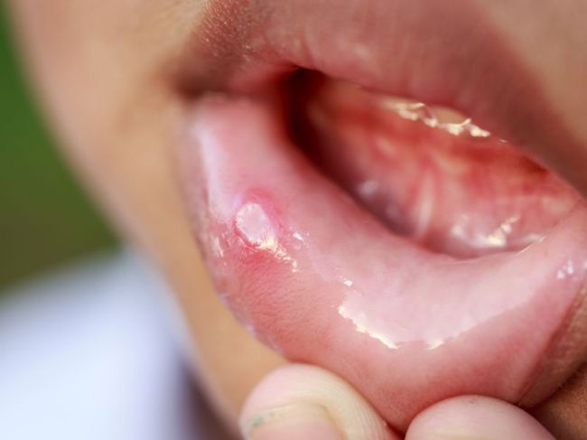 Bolestivé pľuzgiere v ústach: Čo afty spôsobuje a ako ich liečiť?