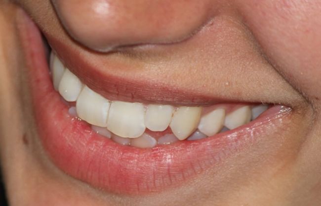 Zubný kameň: Zbavte sa ho efektívne pomocou domácich receptov