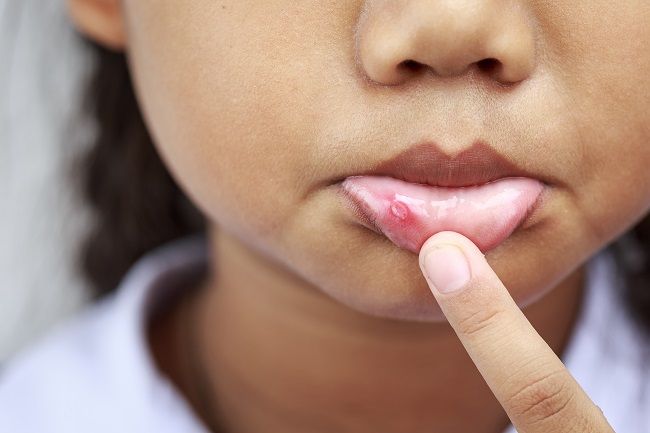 Za afty, opary a infekciu kútikov úst môže aj oslabená imunita