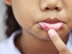 Za afty, opary a infekciu kútikov úst môže aj oslabená imunita