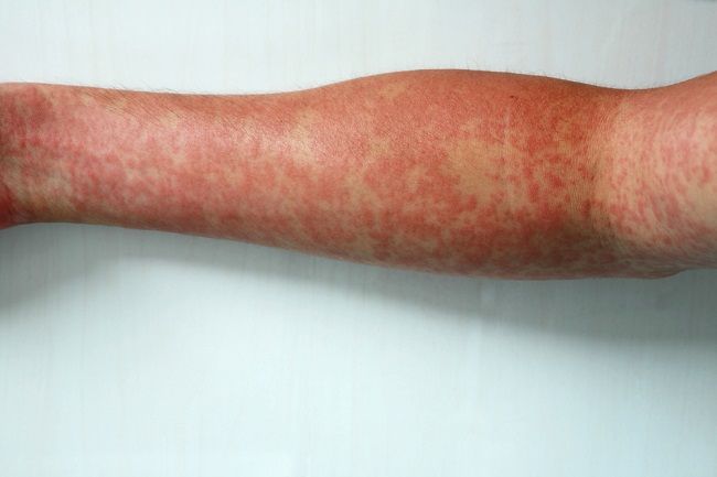 Infekcia kože: 5 domácich liekov