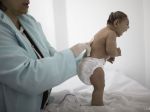 Na východe USA sa narodilo prvé dieťa postihnuté vírusom zika