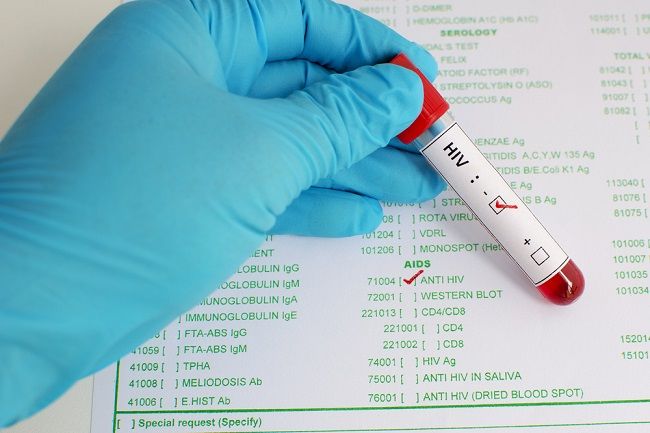 10 najčastejších mýtov o HIV a AIDS a ako je to v skutočnosti