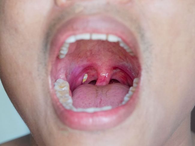 Kedy je zápach z úst príznakom vážneho ochorenia