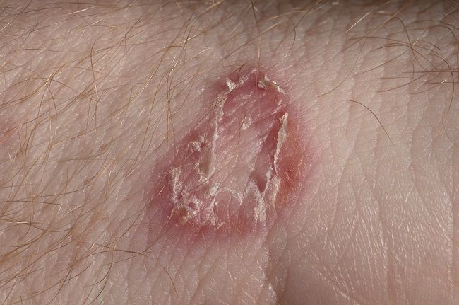 Hubová infekcia kože: 5 spôsobov, ako ju liečiť