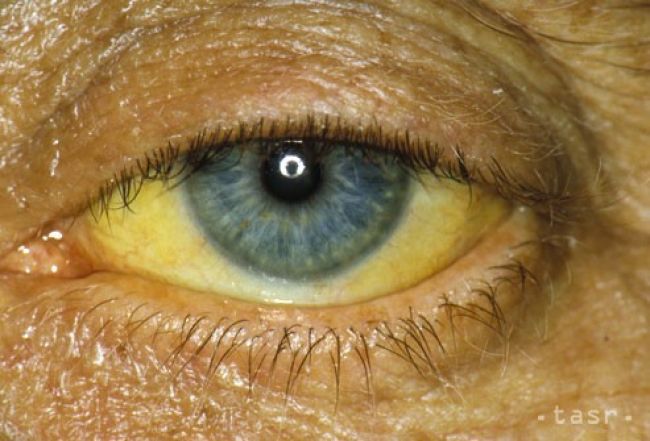 WHO vyzýva na lepšie poznanie hepatitídy a na jej odstránenie