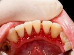 RADÍME: Parodontitídu ľudia podceňujú, môže ich to stáť zuby