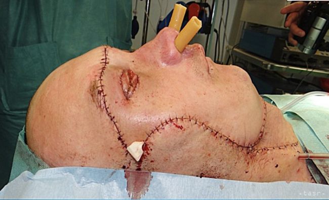 Zomrela žena, ktorej ako prvej na svete transplantovali tvár