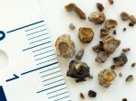 Obličkové kamene: Varovné a príznaky a 10 prírodných liekov, ktoré pomáhajú