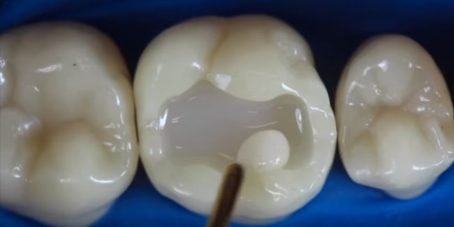 Video: Takto to vyzerá, keď nám zubár ošetruje zubný kaz