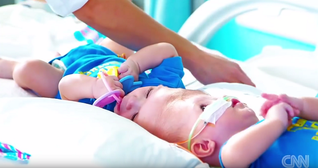 Video: Siamské dvojčatá podstúpili riskantnú operáciu