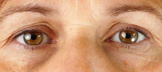 Tmavé kruhy okolo očí môžu byť znakom vážnejšieho problému