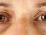 Tmavé kruhy okolo očí môžu byť znakom vážnejšieho problému