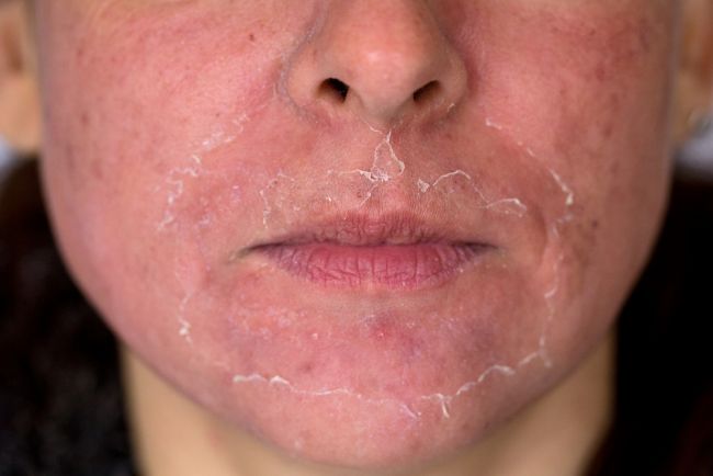 Nepríjemné šúpanie pokožky: 5 domácich spôsobov liečby