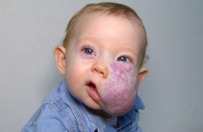 Video: Bábätko sa narodilo s nádorom na tvári. Podstúpilo neuveriteľnú premenu