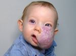 Video: Bábätko sa narodilo s nádorom na tvári. Podstúpilo neuveriteľnú premenu