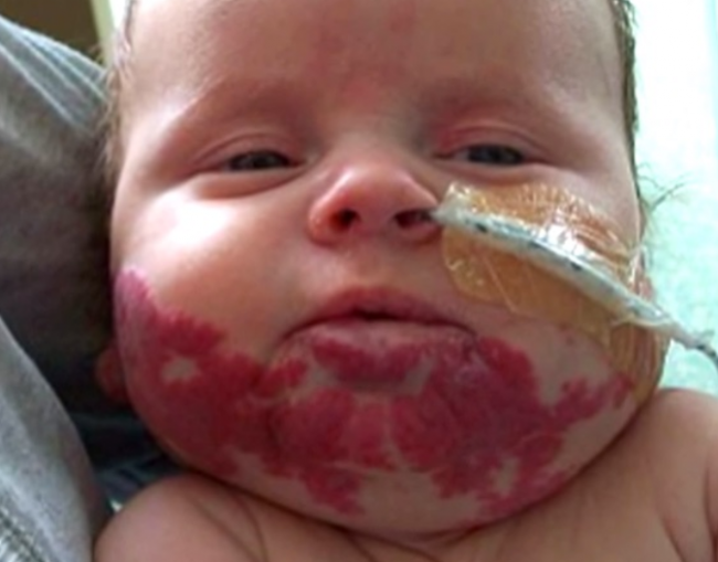 Video: Chlapčeka dusili škvrny na tvári. Lekári mu podali lieky na tlak