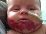 Video: Chlapčeka dusili škvrny na tvári. Lekári mu podali lieky na tlak