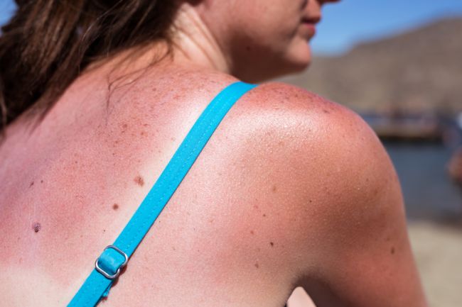 Pokožka spálená od slnka: Prevencia, rady a prírodné ošetrenie