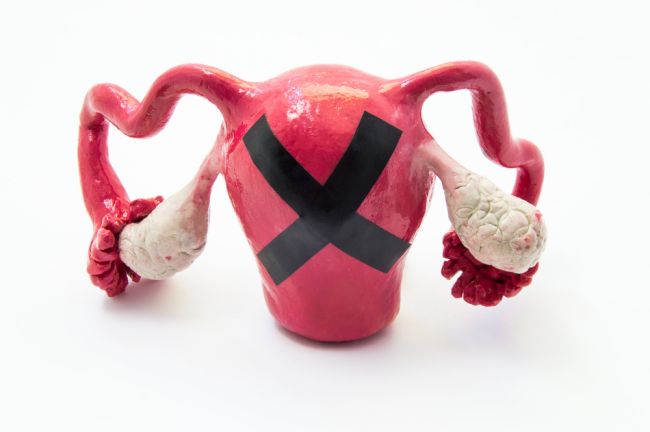 Endometrióza: Neznámy postrach, ktorý postihuje mnoho nič netušiacich žien