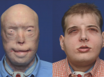Video: Riskantná transplantácia tváre vrátila odvážnemu hasičovi späť jeho život