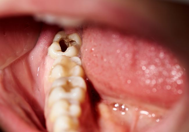 Zubné plomby dokáže nahradiť liek, ktorý bežne dostať v lekárni