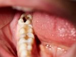Zubné plomby dokáže nahradiť liek, ktorý bežne dostať v lekárni