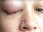 Video: Potetovaná žena plače fialové slzy a čiastočne stratila zrak
