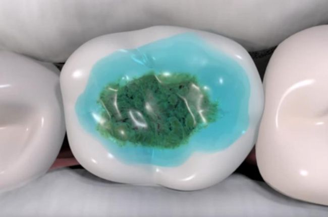 Video: Takto sa dá liečiť zubný kaz bez vŕtania