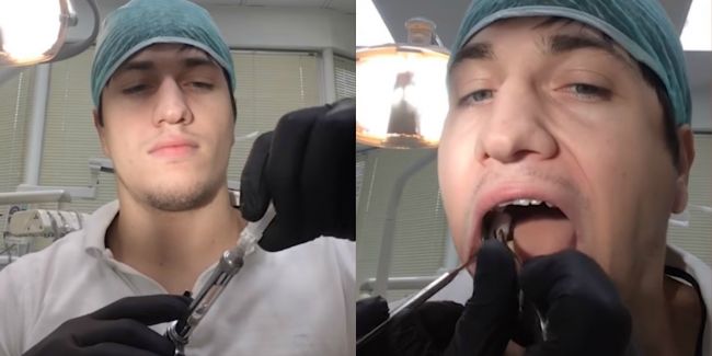 Video: Zubár si sám vytrhol zub a zašil ranu