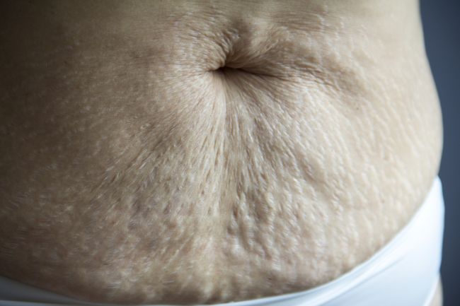 10 spôsobov, ako sa zbaviť ovisnutej kože po pôrode