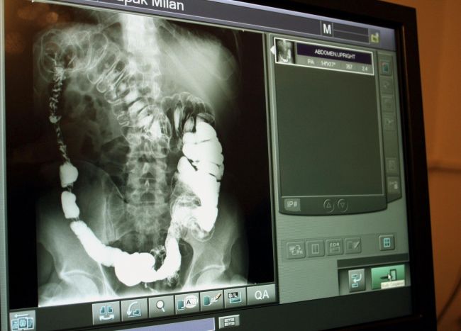 Pacientka zomrela, keď na ňu pri vyšetrení v nemocnici spadol röntgen