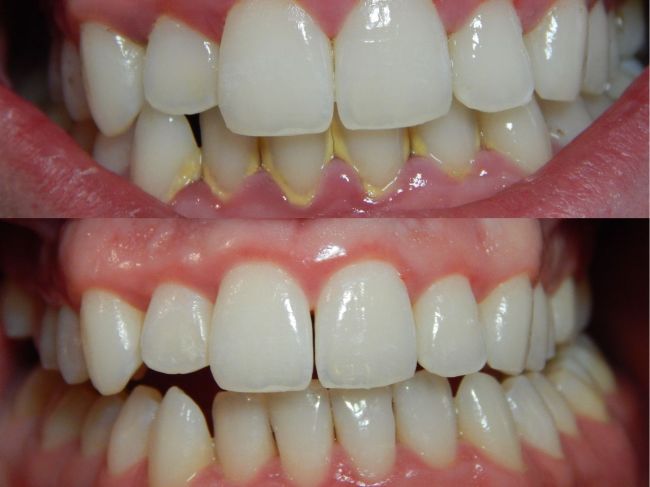 Zubný povlak: 6 efektívnych spôsobov, ako sa ho zbaviť