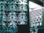 Prelomový objav: Vedcom sa podarilo zvrátiť Alzheimerovu chorobu