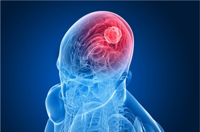 Benígny meningeóm: 5 príznakov najbežnejšieho typu nádoru na mozgu