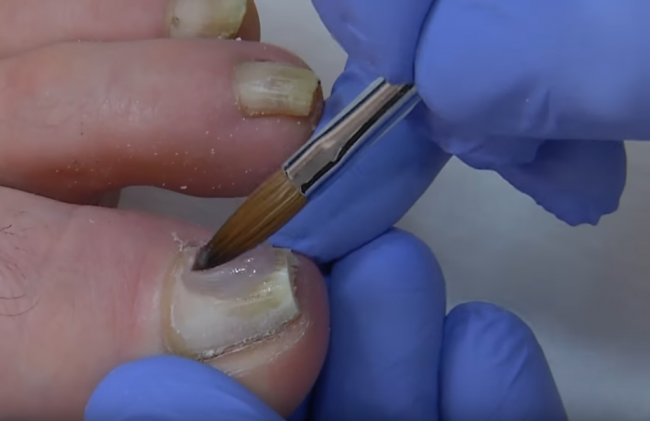 Video: Takto sa dajú liečiť zarastené nechty 