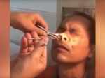 Video: Muža dlhšie bolel nos. Sledujte, čo mu z neho vytiahli!