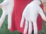 Video: Žena sa narodila iba s troma prstami na pravej ruke