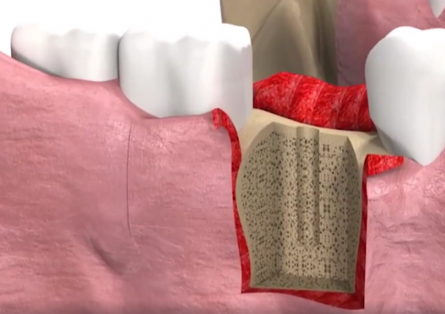 Video: Chceli by ste zubné implantáty? Toto vám hrozí