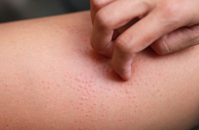 15 bežných predmetov, na ktoré môžete byť alergickí bez toho, aby ste o tom vedeli