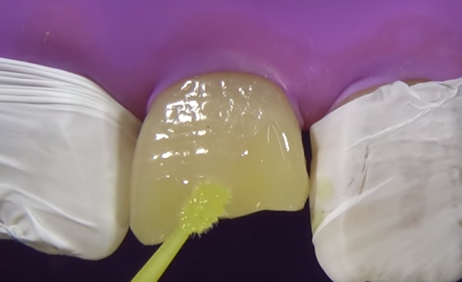 Video: Takto dokážete opraviť zlomený zub