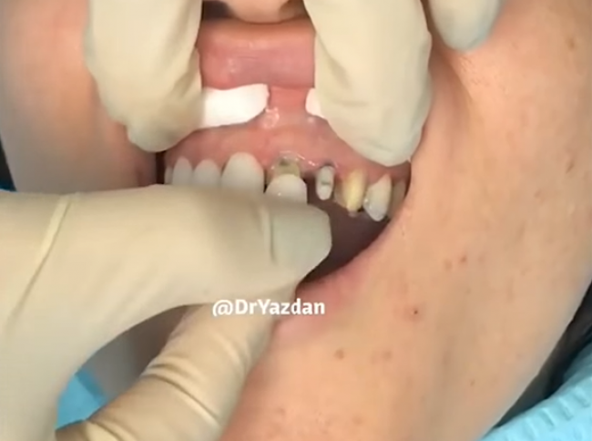 Video: Chceli by ste nové zuby? Toto vás čaká
